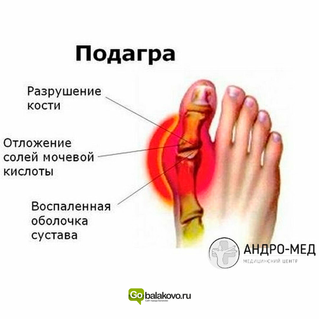 Причины болят пальцы на ногах почему. Суставная болезнь подагра. Подагра большой палец на ноге подагра. Отложение солей мочевой кислоты в суставах. Подагра большого пальца на ноге симптомы у мужчин.